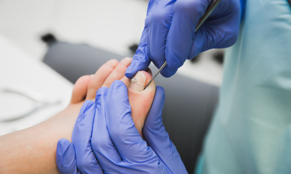 InGrown toenails Treatment