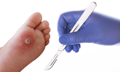 Planter Wart surgery foot cover