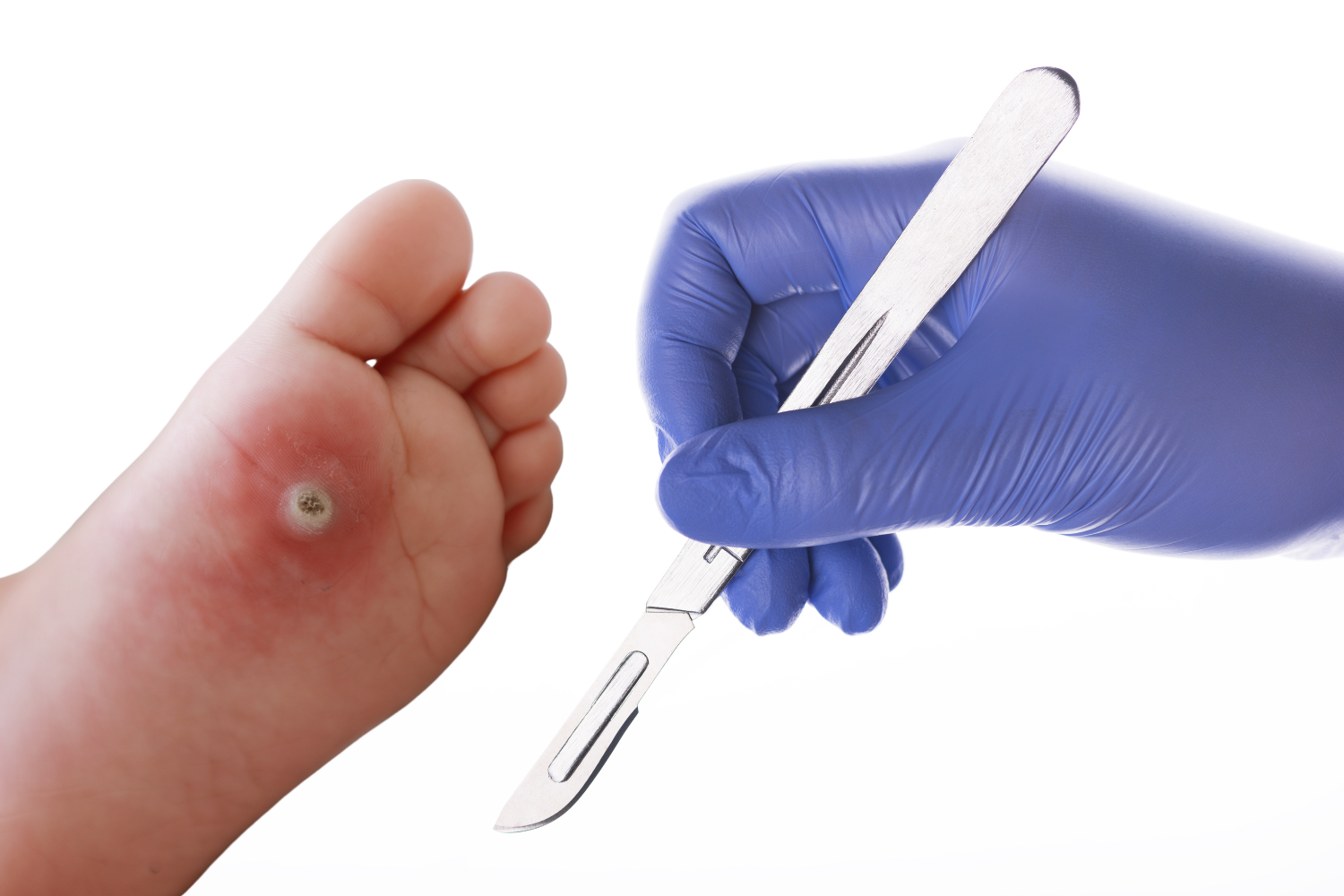 Planter Wart surgery foot cover